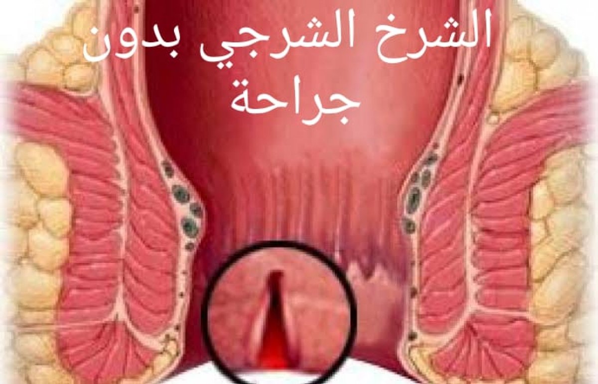 د. محمود أبو صفين يكتب ... "  الشرخ الشرجي بدون جراحة "