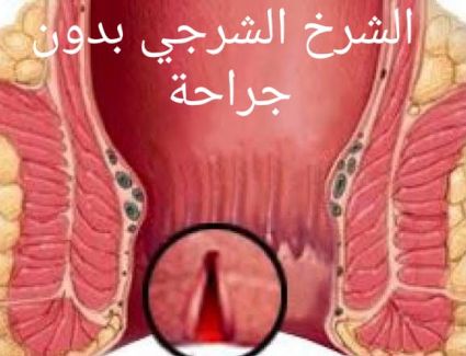 د. محمود أبو صفين يكتب ... "  الشرخ الشرجي بدون جراحة "